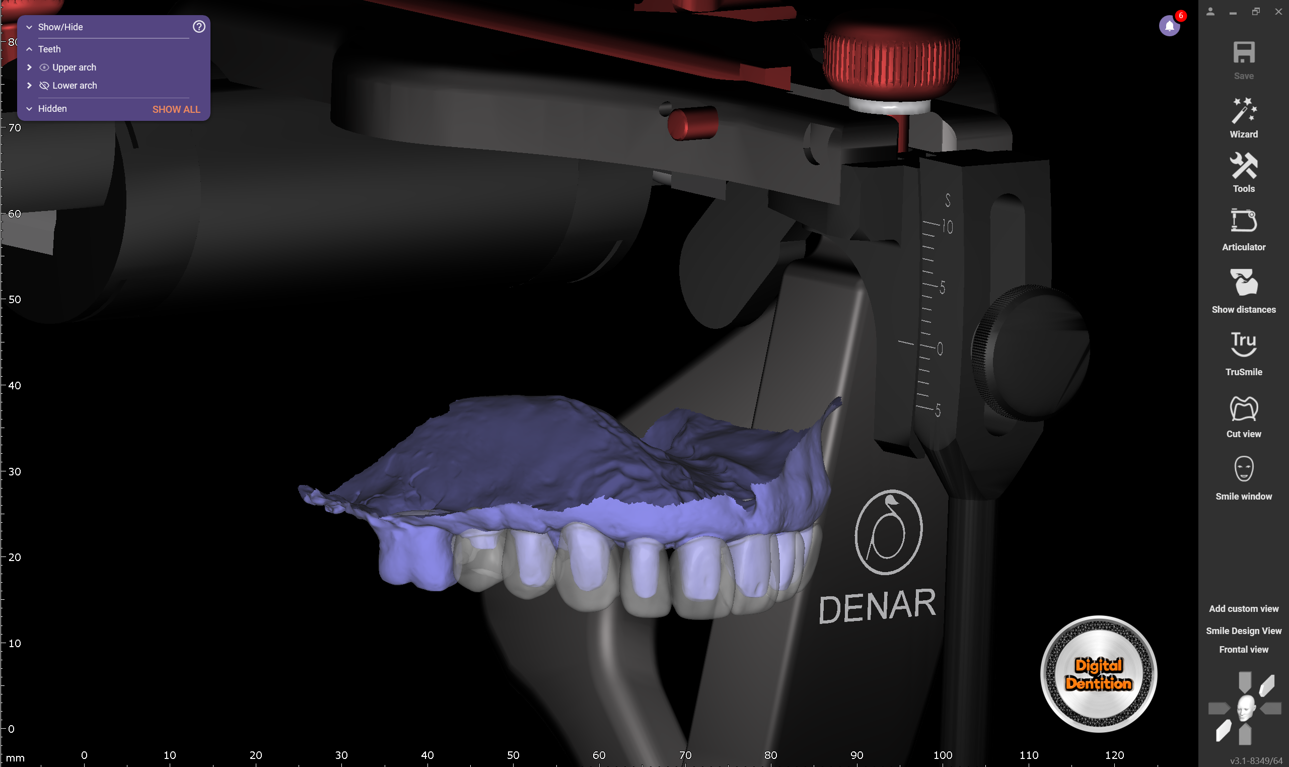 Denar articulator with preps and waxup e1747882058358