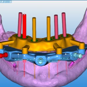 Full Arch One on One Hybrid