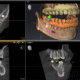 Implantology One on One Hybrid