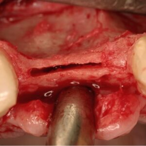 Tissue Grafting In Implantology Hybrid